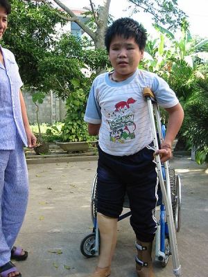 landmine survivor